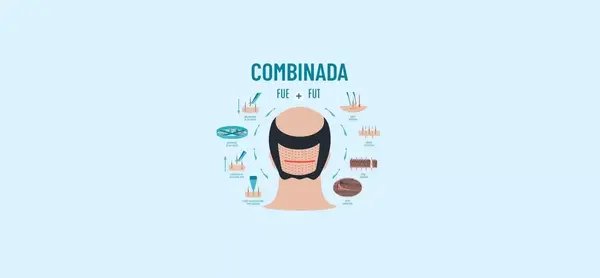 Diagrama da técnica combinada FUE + FUT