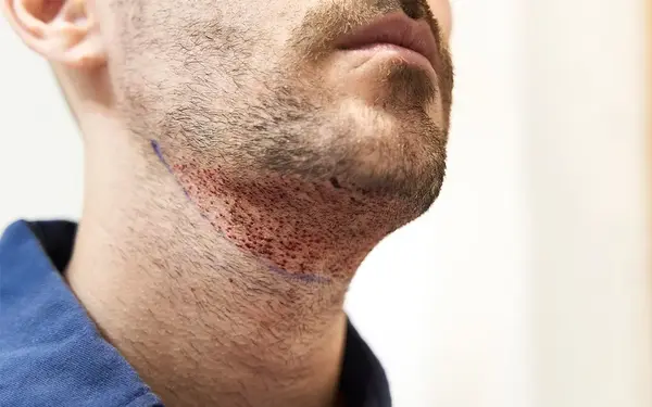 É Possível Transplantar Cabelo da Barba para a Cabeça?