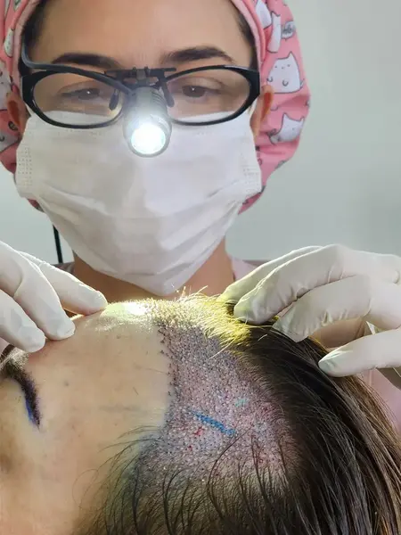 É Possível Fazer Transplante Capilar em Mulheres?
